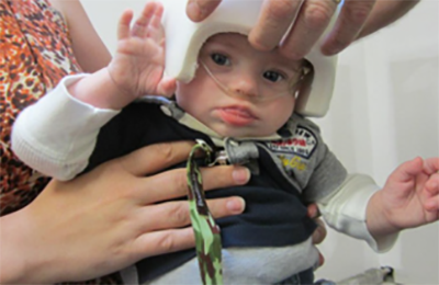 Baby Noah wearing oxygen and a helme.